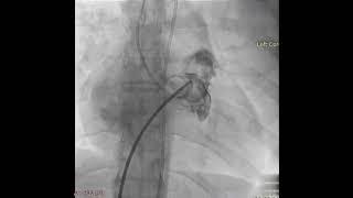 Cinefluroscopy of a Patient With Rheumatic Heart Disease at the Time of Dyspnea