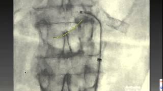 Magellan Case Complex Renal Stenosis Houston Methodist