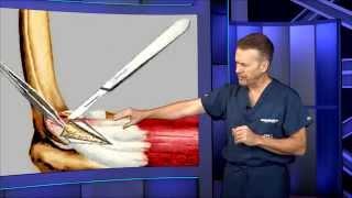 Tennis Elbow Surgery