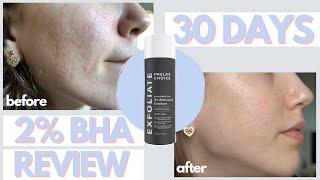 I Used Paulas Choice 2% BHA Liquid Exfoliant On My Acne Scars for 30 Days  Honest Review