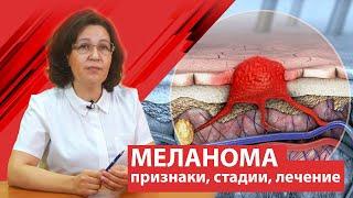 Меланома  рак кожи  . Признаки стадии лечение.