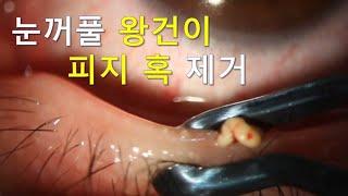 A Really AMAZING Eyelid Squeeze