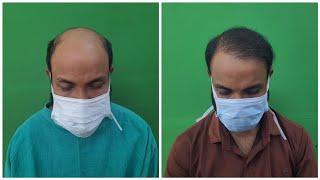 Grade -7 Hair Transplant Result  Fue Hair Transplant  Kolkata  Dr. Jayanta Bain