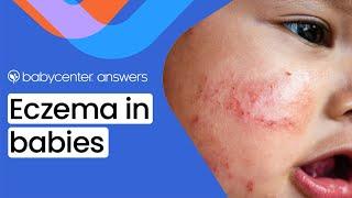 Baby eczema Symptoms triggers and treatments