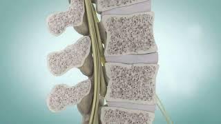Spinal Stenosis and Spine Surgery  Medical Animation