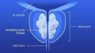 Loyola Minute Benign Prostatic Hyperplasia or BPH