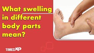 Swelling in different areas of body can indicate underlying health issues  Edema Causes  TimesXP