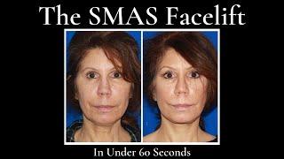 The SMAS Facelift In Under 60 Seconds