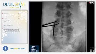 Watch Live Back Treatment DLDR LT L3-L4 RT L4-L5 + DPR BL L3-S1