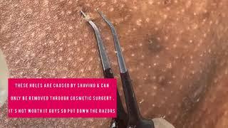 Ingrown hair removal Ep.3