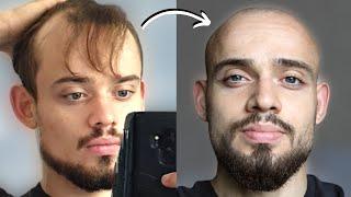 100 BALDING MEN BeforeAfter SHAVING HEAD BALD #2