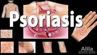 Psoriasis Types Symptoms Causes Pathology and Treatment Animation