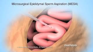Sperm Retrieval for Conception Fertilization