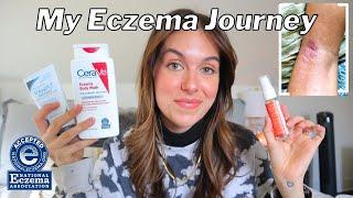 HOW I BEAT MY ECZEMA FOR GOOD  My journey product recommendations + body care tips  Rudi Berry
