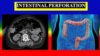 INTESTINAL PERFORATION - Define  causes  symptoms  diagnostic  treatment  complications