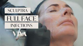 Sculptra Injections in the Face - Restore lost Volume and treat crepey skin  2023