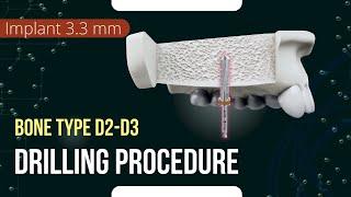 Drilling procedure for XGate Dental X11 and X3 Pure&Porous Implant 3.3 mm diameter bone type D 2-3
