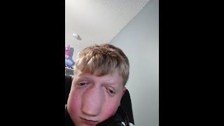 St. Jude cancer patient get exposed.