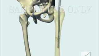 Femoral Fracture Fixation Surgery Intramedullary Nail