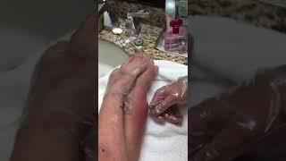 The worst boil popping ever  pus shooting out 