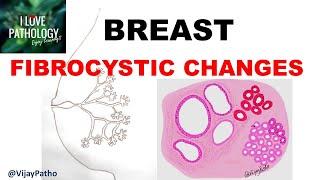 Diseases of Breast Part 1. Normal anatomy Classification & FIBROCYSTIC CHANGES