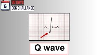 Day 6 Pathological Q waves on ECG  30-Day ECG challenge