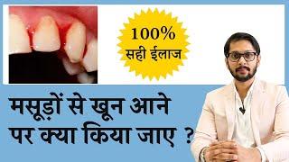 मसूड़ों से खून रोकने के घरेलू उपचार  How to Treat Bleeding gums  Dr Ankit Seraphic Dental Indore