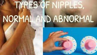 Normal and abnormal types of nipples