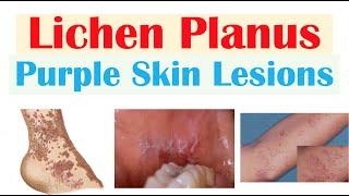 Lichen Planus “Purple Skin Lesions”  Causes Signs & Symptoms Diagnosis Treatment