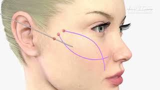 What is Aptos Threadlift?