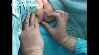 fistula problem in young girl child