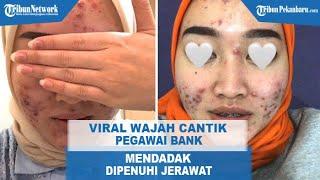 VIRAL Wajah Cantik Pegawai Bank Mendadak Penuh Jerawat yang Ngeri