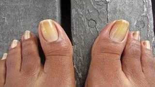 My Natural Toenails