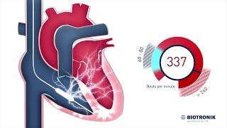 Defibrillatore cardioverter impiantabile - Come funziona