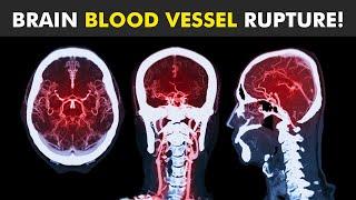 Cerebral Aneurysm  What Causes Bulge in Brain Artery