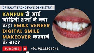 Smile Makeover VENEERS in 3 Days NO BRACES   Prep less Porcelain Veneers Best Dentist in delhi