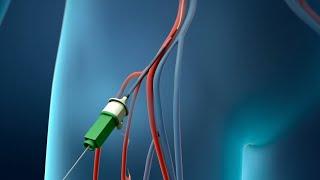 Coronary Angioplasty Femoral Access