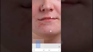 Quickly Remove Pimples from your photo using Snapseed App