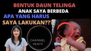 Bentuk Kedua Daun Telinga Anak Saya Berbeda Saya Harus Bagaimana ? Bentuk Daun Telinga Asimetris