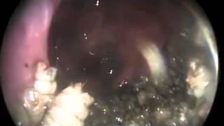 Nasal Myiasis  NEJM