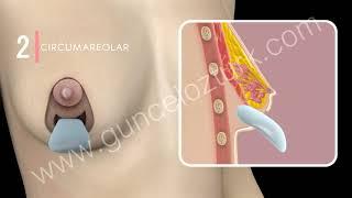 How breast lifting operation is performed?  3D Animation - Dr. Guncel Ozturk #DRGO