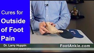 How to Treat Pain on the Outside of the Foot with Seattle Podiatrist Dr. Larry Huppin