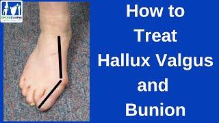 How to Treat Hallux Valgus and Bunion
