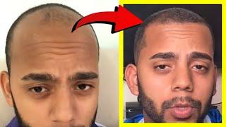 Crazy Minoxidil 5% Hair Growth in 2.5 Months Fails after 2.5 YEARS? Heres WHY