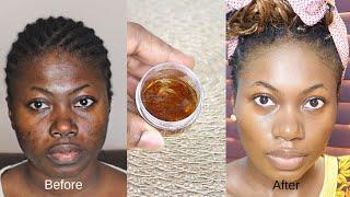 How I got rid of Dark Spots Uneven Skin Tone  Acne and Acne Scars