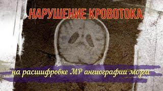 НАРУШЕНИЕ КРОВОТОКА в артериях спутанное сознание и шаткость на РАСШИФРОВКЕ МР ангиографии головы