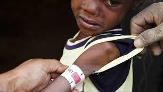 Malnutrition the global threat to the health of refugee children