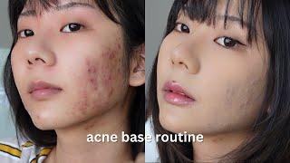 acne skin ʚɞ ༘⋆ acne coverage base routine  cover acne easily with makeup