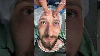 Rhinoplasty - burun ameliyatı öncesi geri sayım.