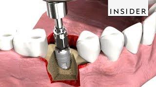 How Dentists Insert Dental Implants